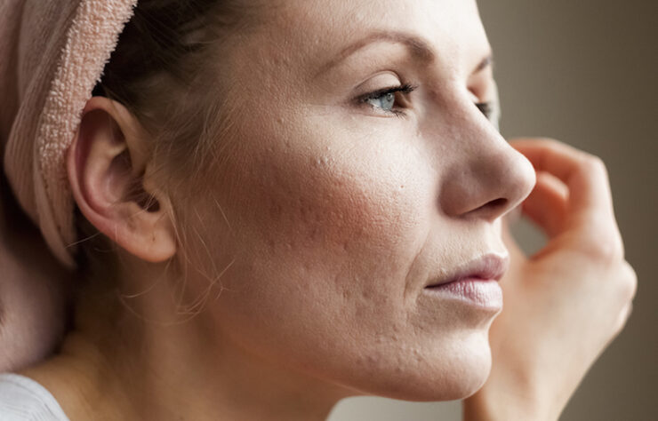 Adult Acne
